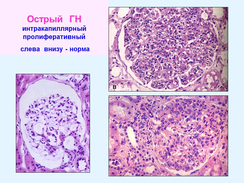 Острый  ГН интракапиллярный пролиферативный   слева  внизу - норма